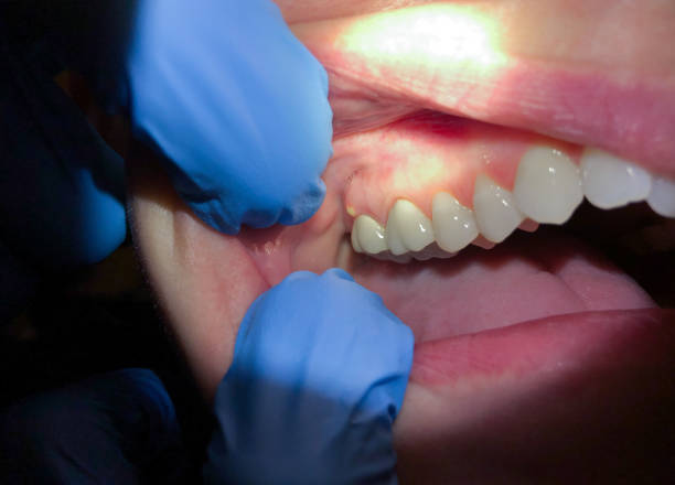 Best Emergency Dental Care for Broken or Chipped Teeth in Myrtle Creek, OR